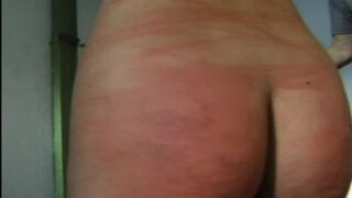 Vergões em abundância